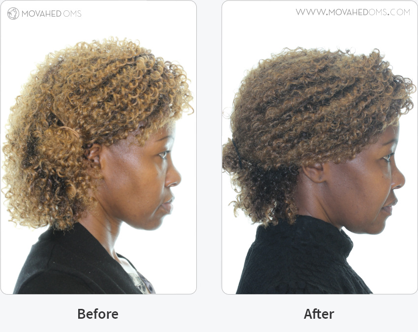 Using a method other than those described above, can the case slippage problem be solved? picture