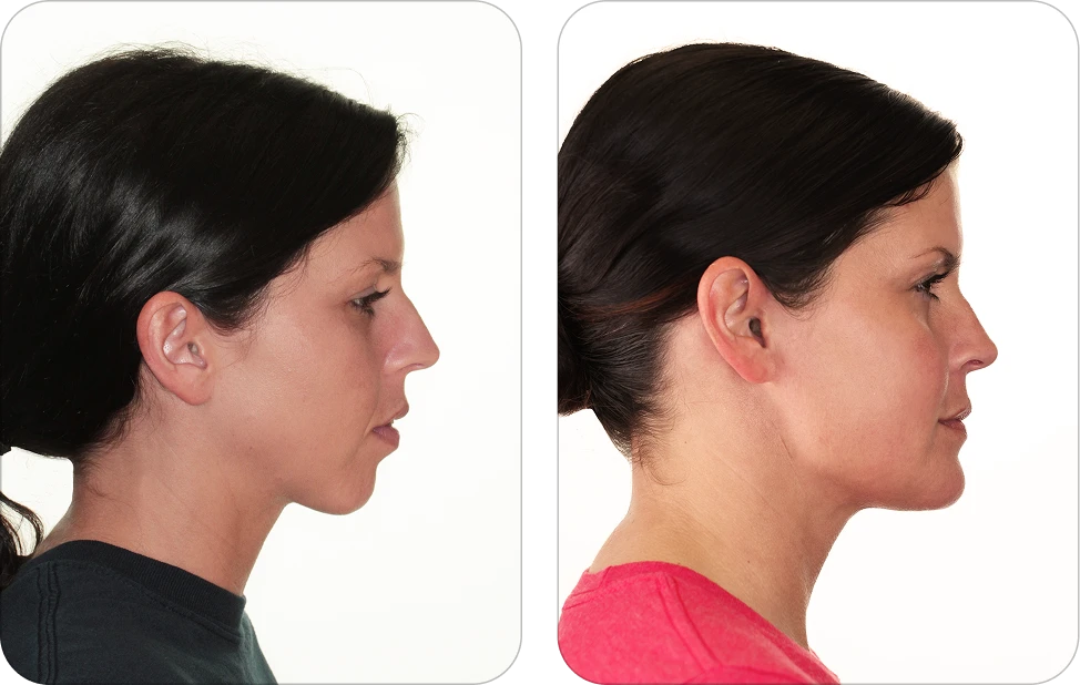 Before-and-after side-profile photos of a woman, showing an improved jawline and neck after treatment (left vs. right).