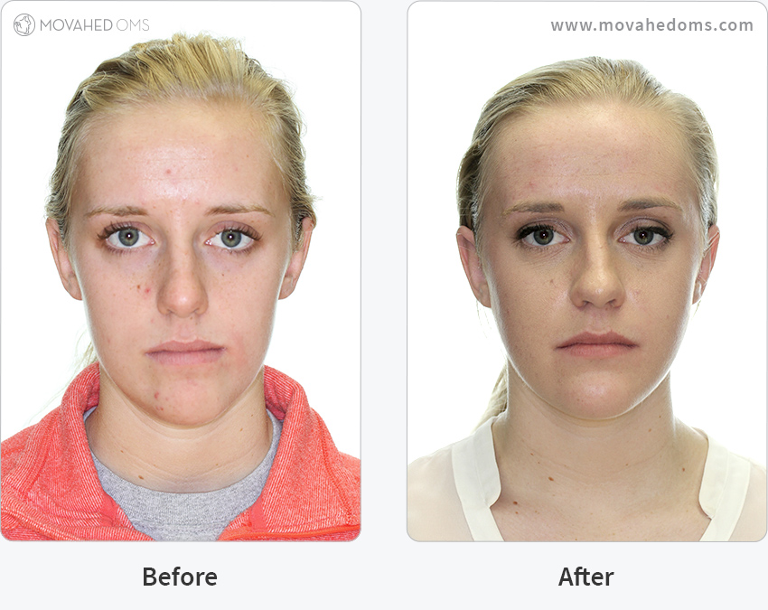 Double Jaw Surgery Before And After Case Study Movahed OMS.