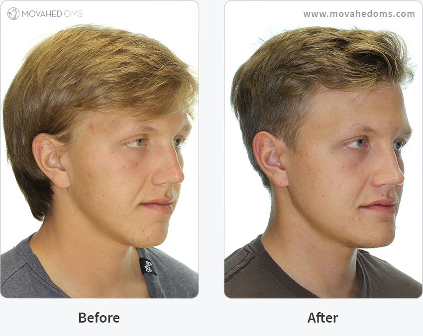 Corrective Jaw Surgery CS Double Jaw Surgery Movahed OMS