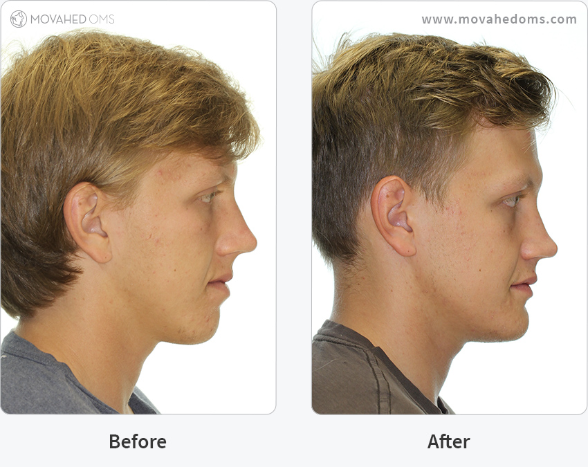 Corrective Jaw Surgery Cs Double Jaw Surgery Movahed Oms