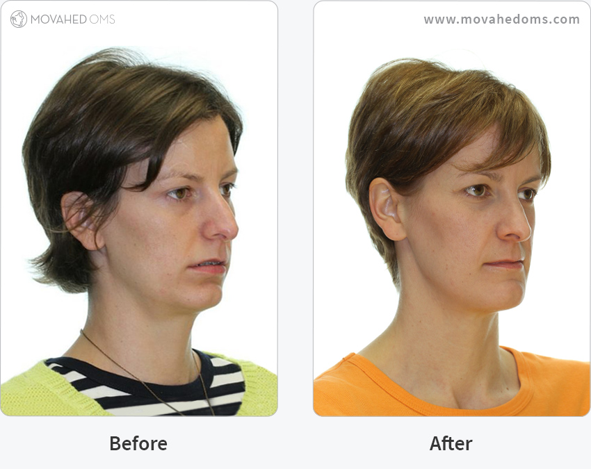 Case Study Combined Total Joint Replacement with Orthognathic Surgery