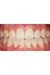 Front close up of intraoral after