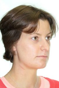 Side profile of woman after temporomandibular joint tmj surgery